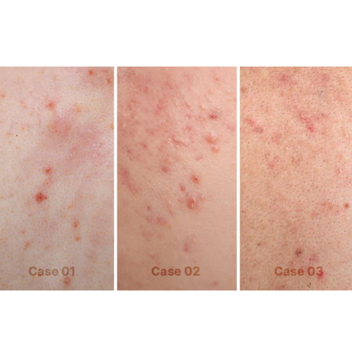 MEDICUBE RED ACNE SUCCINIC ACID PEEL 40G